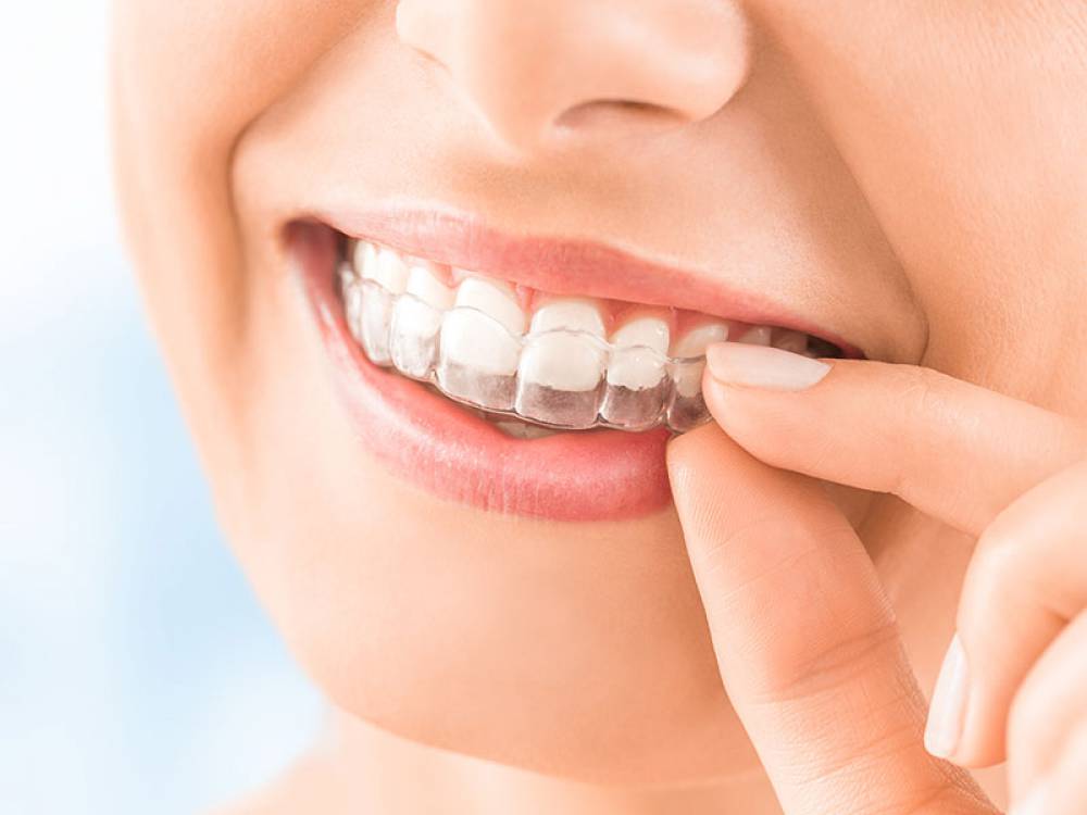 The benefits of Invisalign