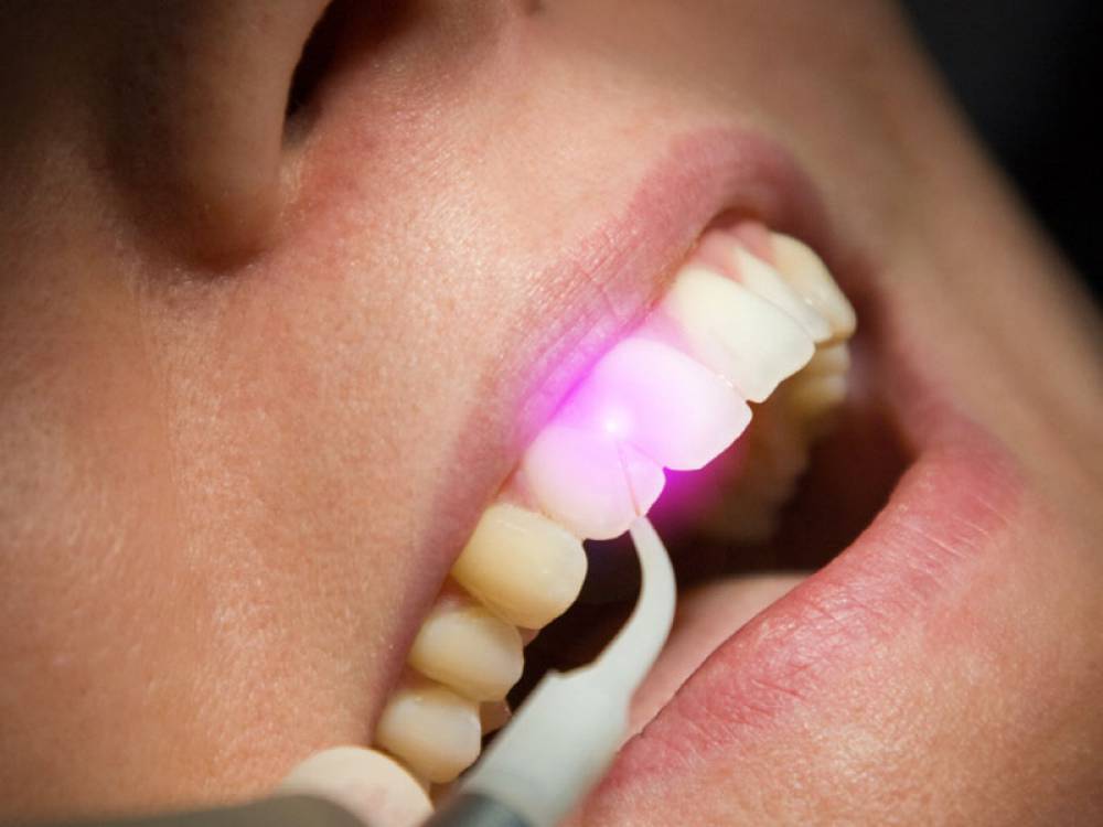 The Advantages of Laser Dentistry